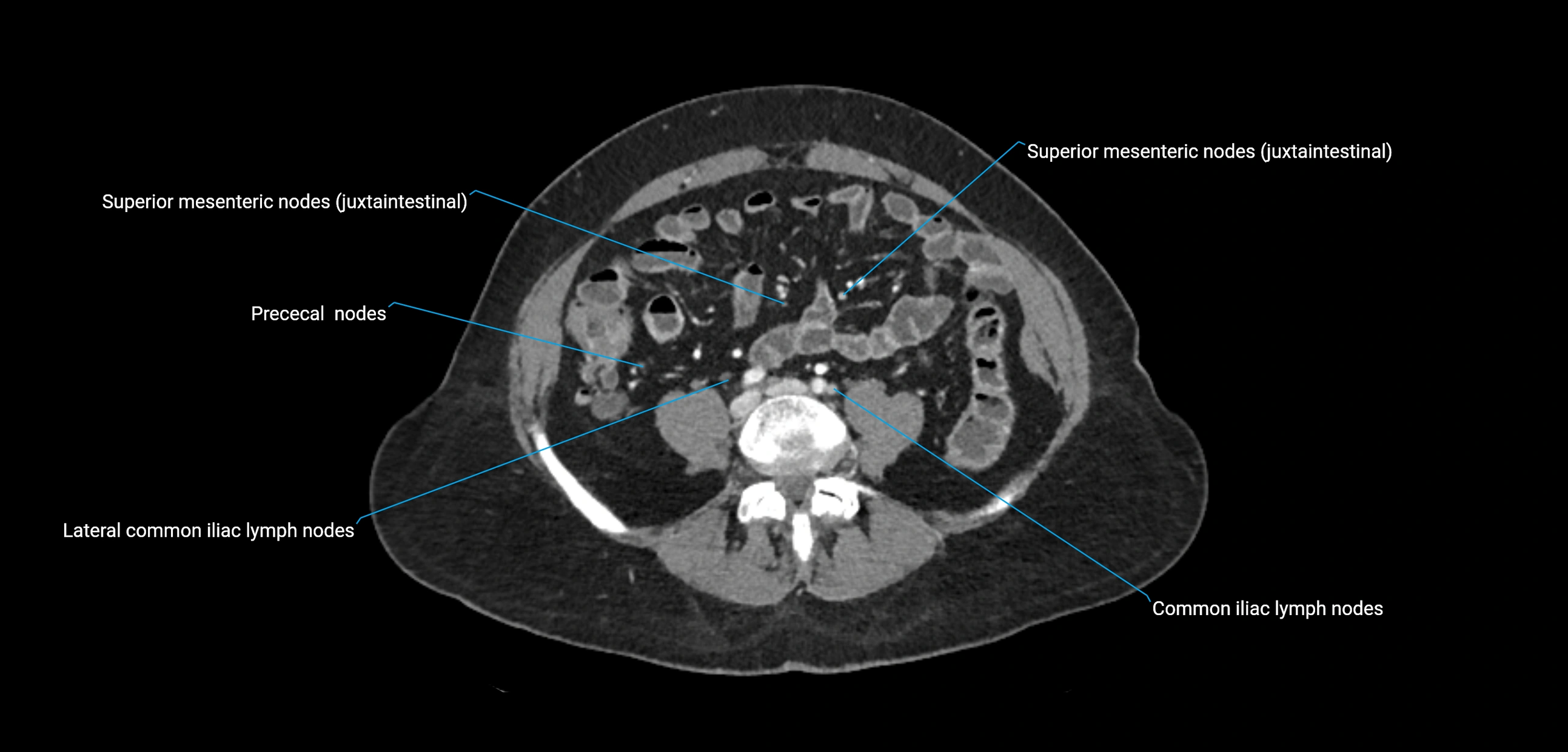 CT ct abdominal lymph nodes  axial cross sectional anatomy  enchanced radiology image -img-00002-00283.webp